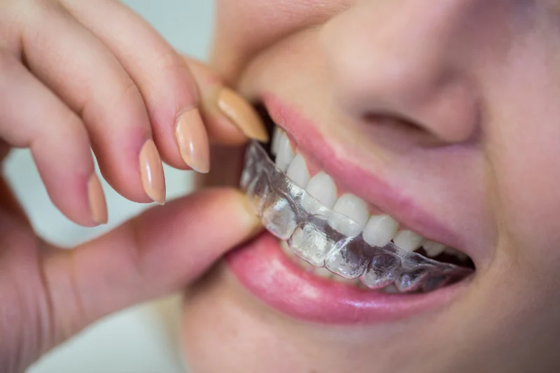 Invisalign ou Aparelho Fixo?